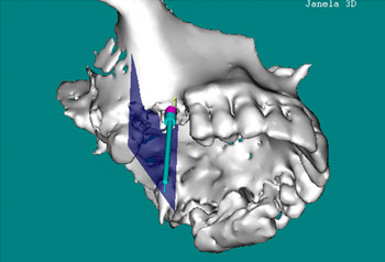 Implantes Dentários com Técnicas Avançadas