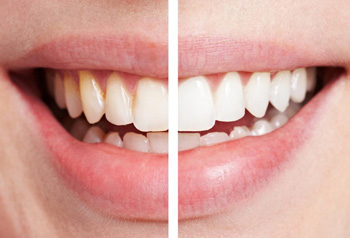 clareamento-dentes-brancos-dentes-amarelados-tratamento