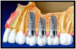 Implantes Dentários com colocação imediata dos dentes