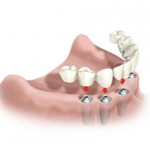 Substituição da dentadura por Implantes