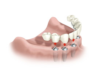 Substituição da dentadura por Implantes