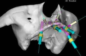 Implante dentário com Cirurgia 3