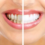 Como funciona o processo de clareamento dos dentes?