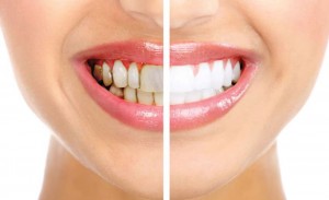 Como funciona o processo de clareamento dos dentes?