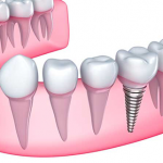 Como funciona o processo de um implante dentário