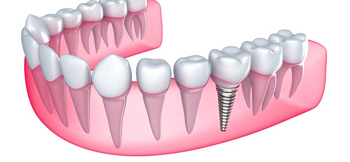 Localização dos implantes metálicos inseridos na maxila e na