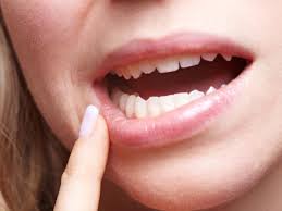 Como tratar a Erosão dentária?