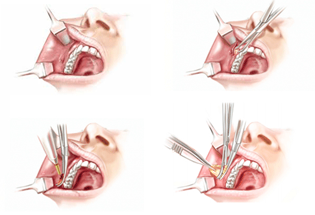 cirurgia-de-bichectomia