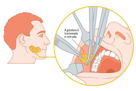 retirada-da-gordura-bochecha
