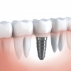 implante-dentário