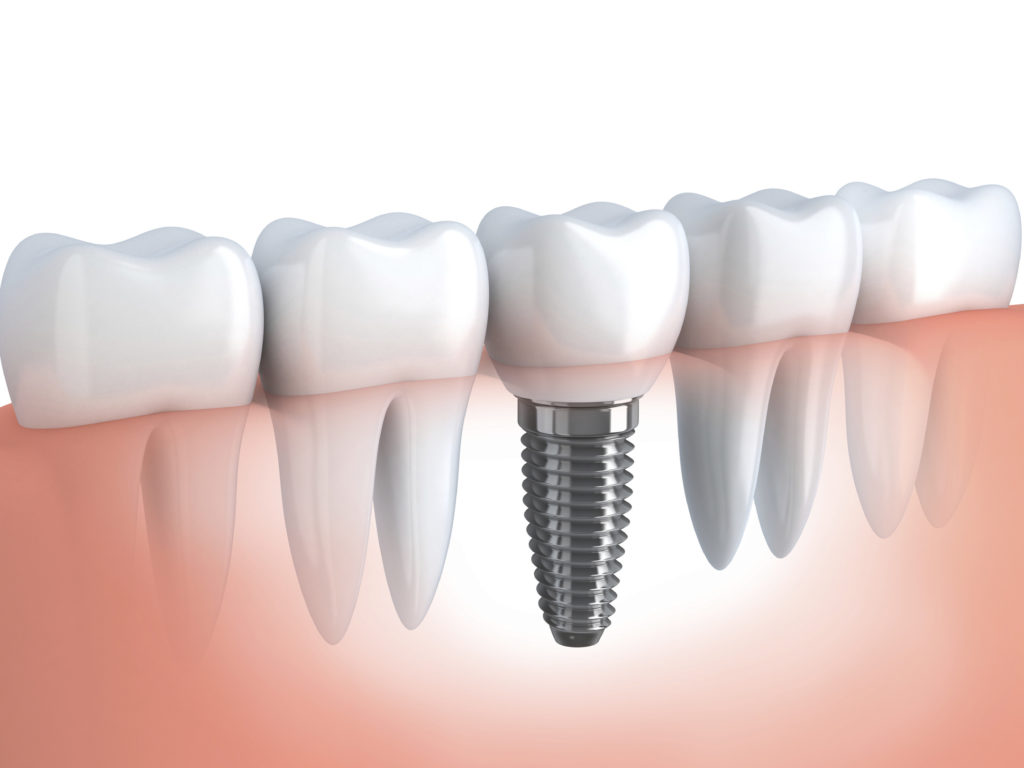 Implante dentário em vez de dentadura
