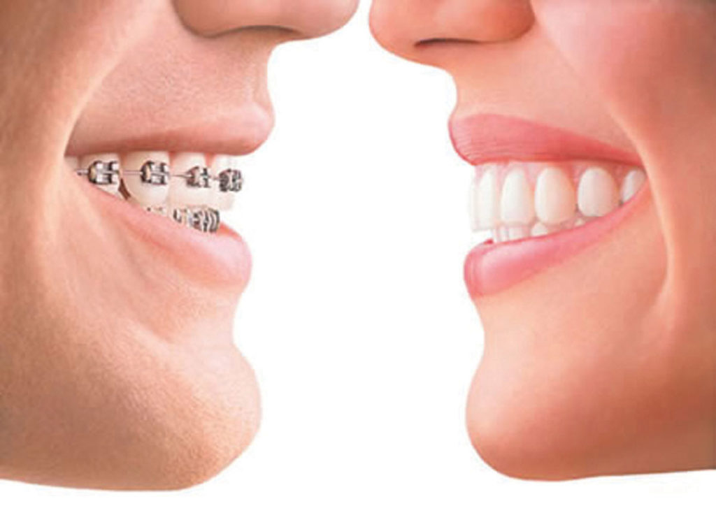 Procedimento para tratamento ortodontico