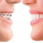 Procedimento para tratamento ortodontico