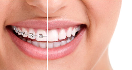 5 sinais de que você precisa usar um Aparelho Dentário