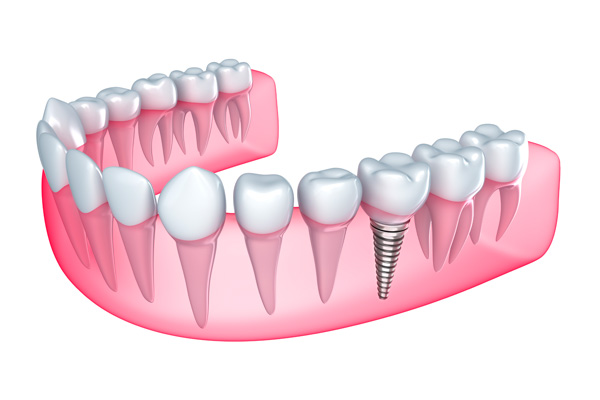 Conheça os avanços da Implantodontia