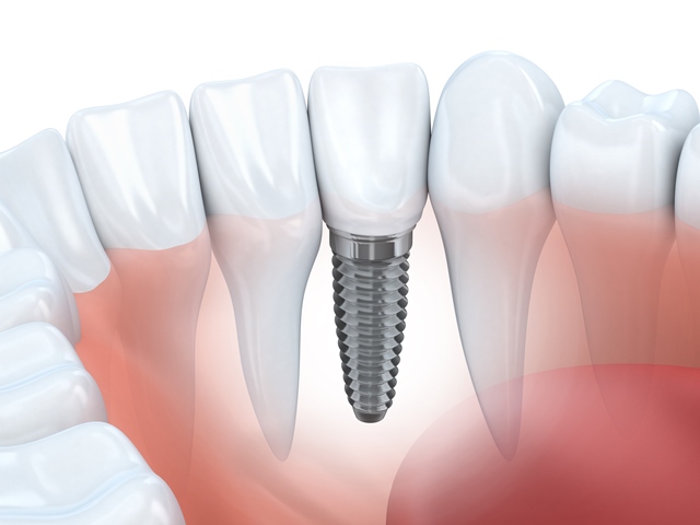 Quais as vantagens do aparelho dentário?