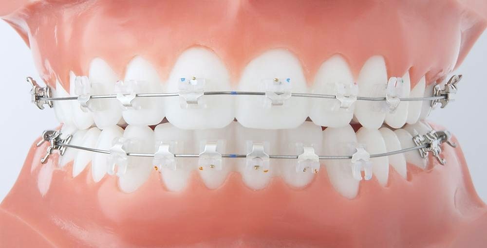 Quais as vantagens do aparelho dentário?