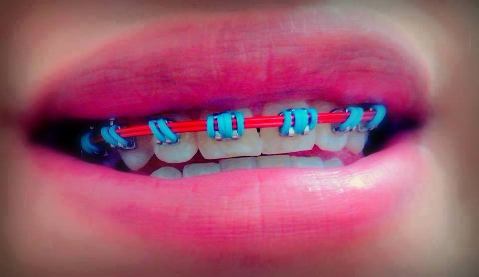 Conheça os riscos de um aparelho dentário falso 'pirata'