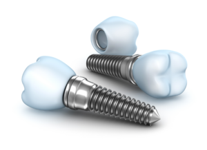 Implante dentario