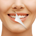 Quais são os tipos de clareamento dental?