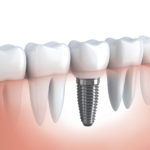 Saiba tudo sobre os implantes dentários!