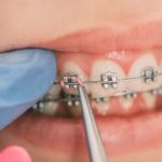 O que você precisa saber sobre Ortodontia