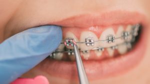 O que você precisa saber sobre Ortodontia