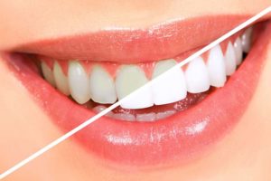 Quais os benefícios do clareamento dental?