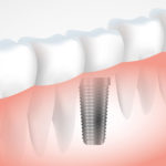 Quando devo realizar implante dentário?