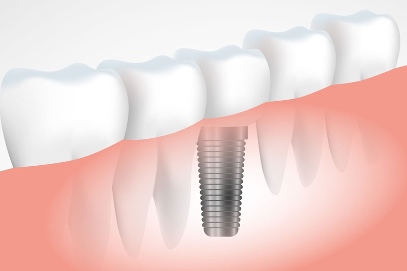 Quando devo realizar implante dentário?