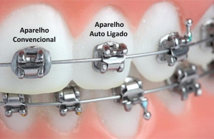 Aparelho autoligado - siga odontologia