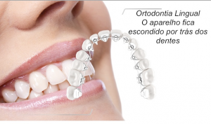 Aparelho lingual