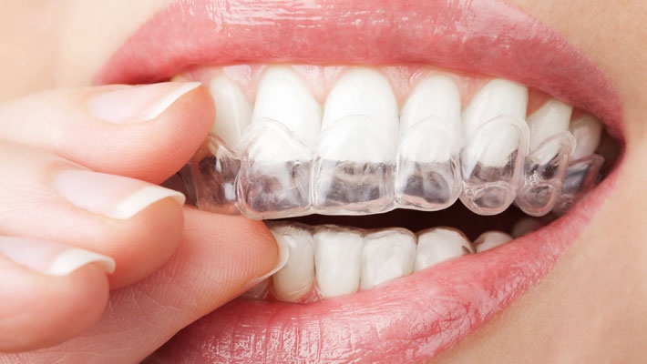 Clareamento dental Caseiro