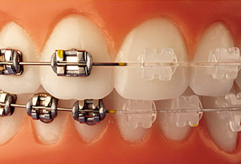 brackets-safira-aparelho-ortodontico