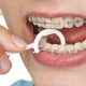 ortodontia limpeza