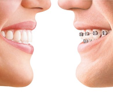 O que saber antes de começar um tratamento ortodôntico - Implantes  dentários e Ortodontia - Siga Odontologia