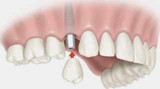implante dental com carga imediata