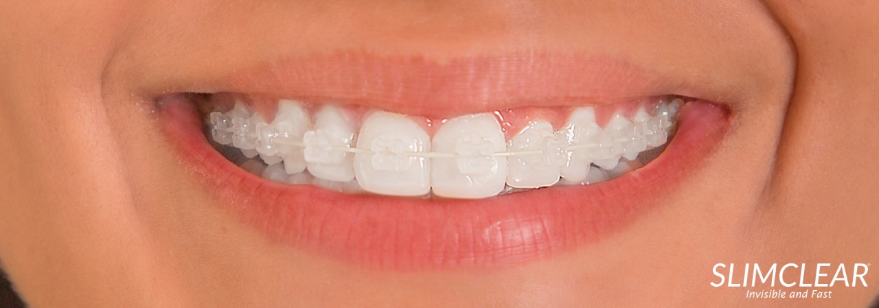 Tratamento Ortodôntico Slimclear (1)